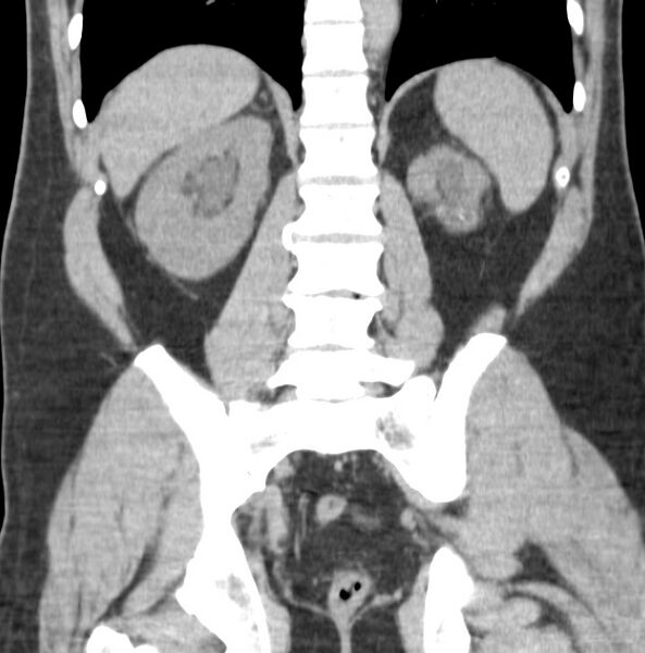 File:Atrophic kidney due to severe chronic obstructive hydronephrosis (Radiopaedia 40828-43474 Coronal non-contrast 8).jpg