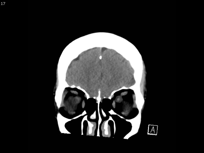 Atypical meningioma - intraosseous (Radiopaedia 64915-73867 B 16).jpg