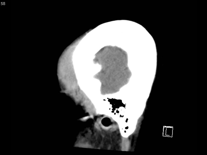 Atypical meningioma - intraosseous (Radiopaedia 64915-73867 C 56).jpg