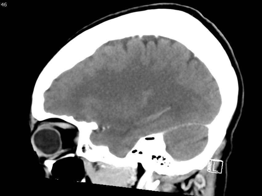 Atypical meningioma - intraosseous (Radiopaedia 64915-73867 F 45).jpg