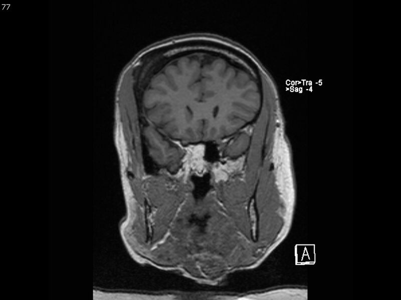 File:Atypical meningioma - intraosseous (Radiopaedia 64915-74572 Coronal T1 77).jpg