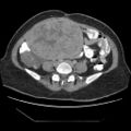 Atypical retroperitoneal lymphocoeles with large leiomyoma of uterus (Radiopaedia 32084-33024 A 25).jpg