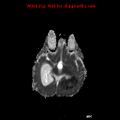Atypical teratoid rhabdoid tumor (Radiopaedia 10712-11183 Axial ADC 10).jpg