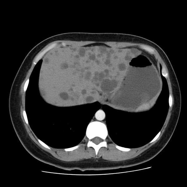 File:Autosomal dominant polycystic kidney disease (Radiopaedia 23061-23093 B 11).jpg