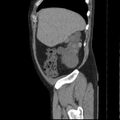 Autosomal dominant polycystic kidney disease (Radiopaedia 36539-38101 D 15).jpg