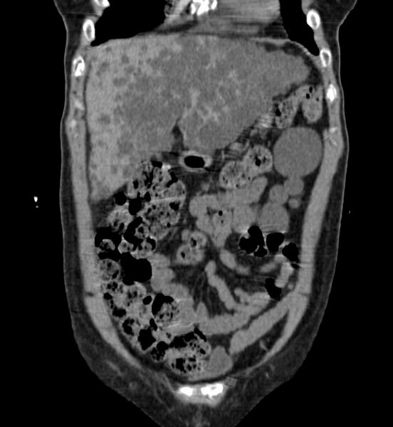 File:Autosomal dominant polycystic kidney disease (Radiopaedia 41918-44922 Coronal non-contrast 1).jpg