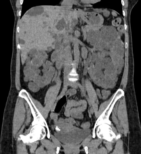 File:Autosomal dominant polycystic kidney disease (Radiopaedia 41918-44922 Coronal non-contrast 20).jpg
