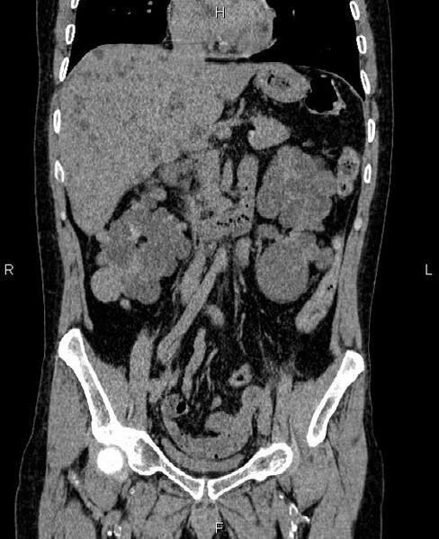 File:Autosomal dominant polycystic kidney disease (Radiopaedia 87830-104287 Coronal non-contrast 26).jpg