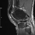 Avulsion fracture of the fibular head (Radiopaedia 74804-85808 Sagittal PD fat sat 27).jpg