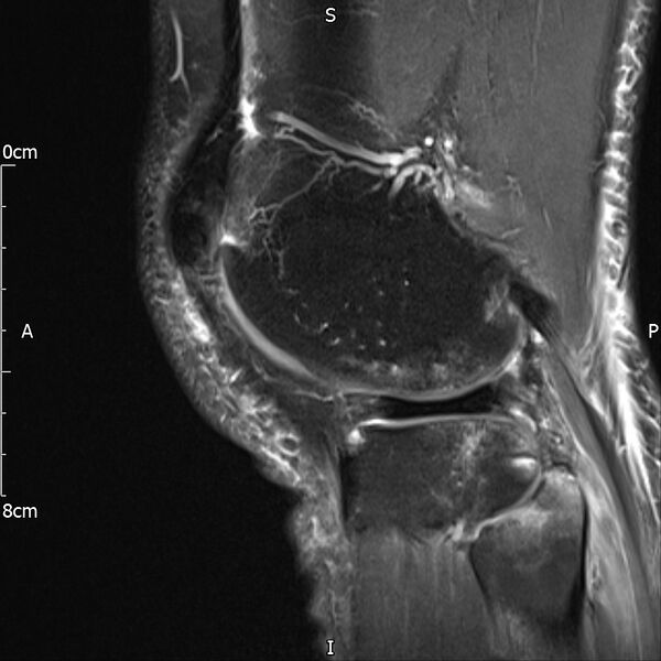 File:Avulsion fracture of the fibular head (Radiopaedia 74804-85808 Sagittal PD fat sat 27).jpg