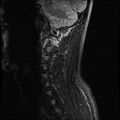 Axis fracture - MRI (Radiopaedia 71925-82375 Sagittal STIR 8).jpg
