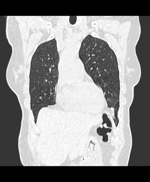 File:Azygos fissure and azygos lobe (Radiopaedia 41841-44832 Coronal lung window 1).jpg