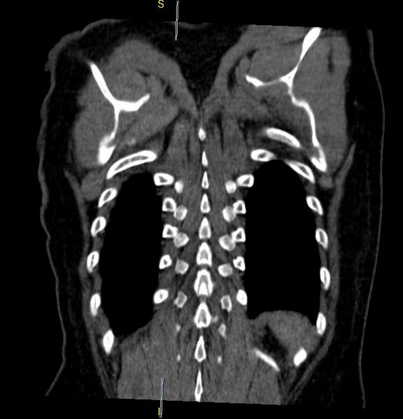File:Azygos vein aneurysm (Radiopaedia 77824-90130 C 28).JPG