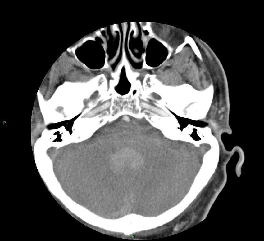 Basal ganglia hemorrhage (Radiopaedia 58763-65985 D 44).jpg