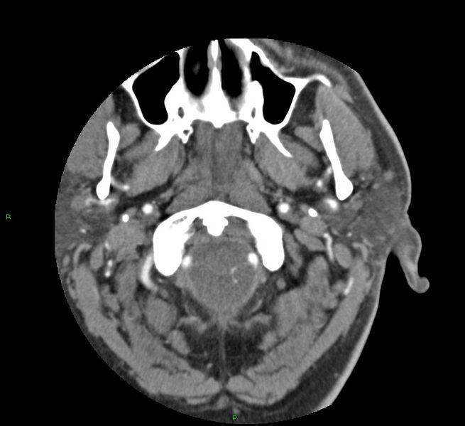 File:Basal ganglia hemorrhage (Radiopaedia 58763-65985 D 9).jpg