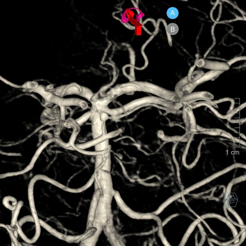 Basilar artery perforator aneurysm (Radiopaedia 82455-97734 3D view left VA 164).jpg