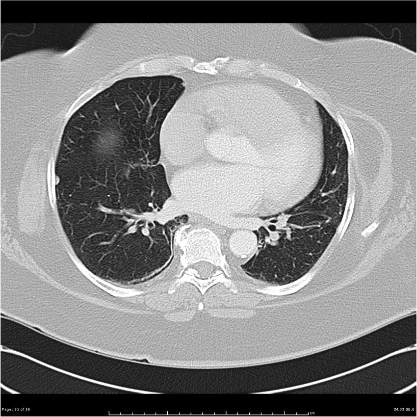 Benign metastasizing leiomyoma (Radiopaedia 26803-26962 Axial lung window 31).jpg