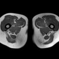 Bicornuate uterus (Radiopaedia 61974-70046 Axial T1 50).jpg