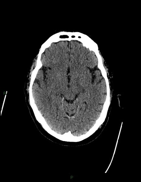 File:Bilateral acute middle cerebral artery territory infarcts (Radiopaedia 77319-89401 Axial non-contrast 36).jpg