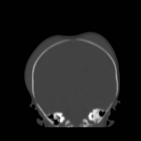 File:Bilateral cephalohematomas and subdural hematomas (Radiopaedia 26778-26929 Coronal bone window 15).jpg