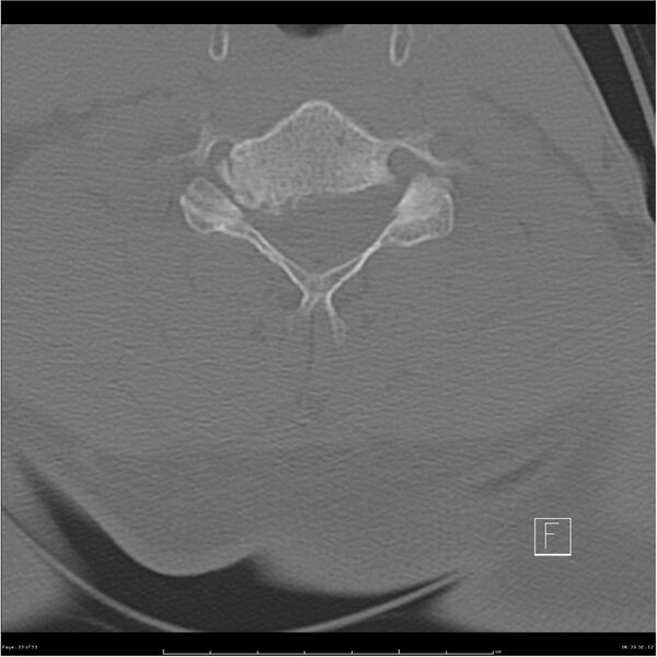 File:Bilateral cervical ribs (Radiopaedia 25868-26017 Axial bone window 33).jpg