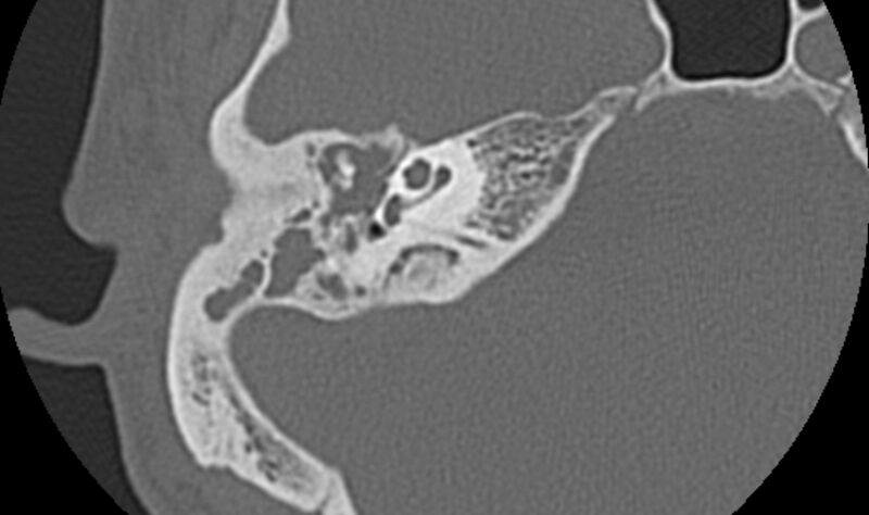 File:Bilateral cholesteatoma (Radiopaedia 54898-61172 Axial bone window 21).jpg