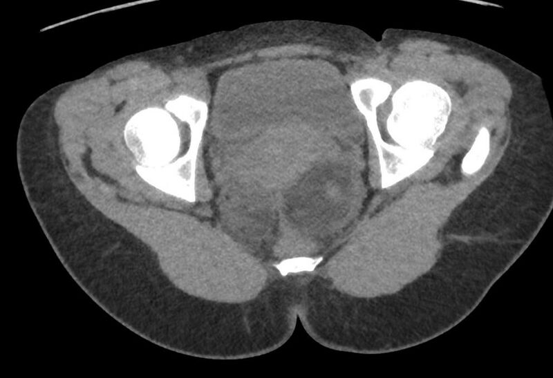File:Bilateral mature cystic ovarian teratoma (Radiopaedia 88821-105592 Axial non-contrast 44).jpg