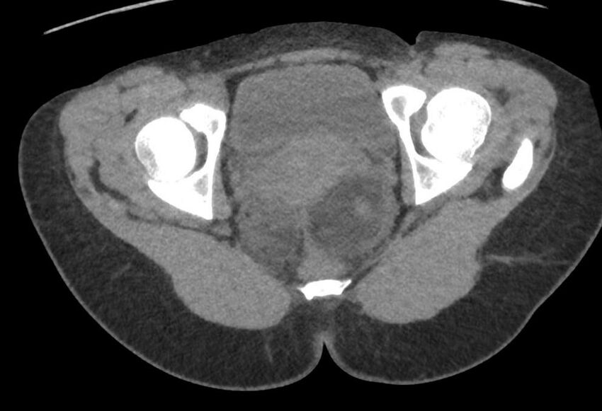 Bilateral mature cystic ovarian teratoma (Radiopaedia 88821-105592 Axial non-contrast 44).jpg