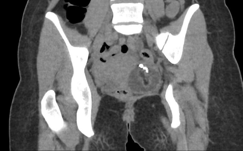 File:Bilateral mature cystic ovarian teratoma (Radiopaedia 88821-105592 Coronal non-contrast 20).jpg