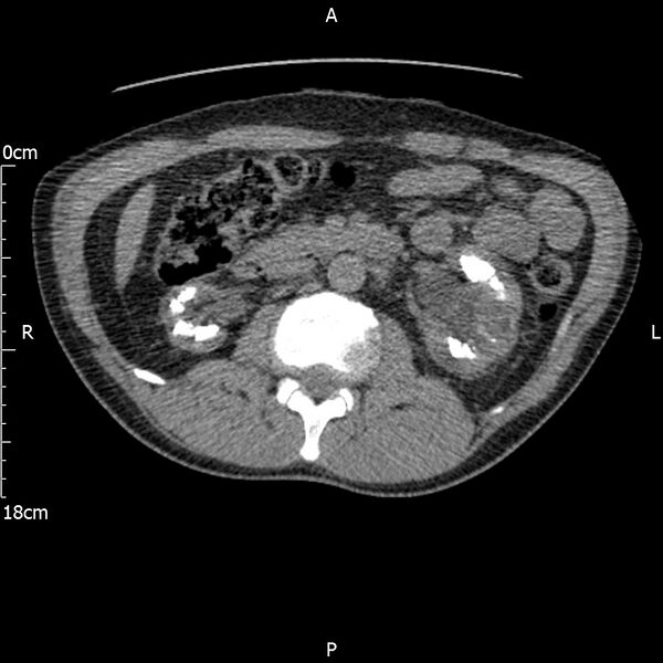 File:Bilateral medullary nephrocalcinosis with ureteric calculi (Radiopaedia 71269-81569 Axial non-contrast 47).jpg
