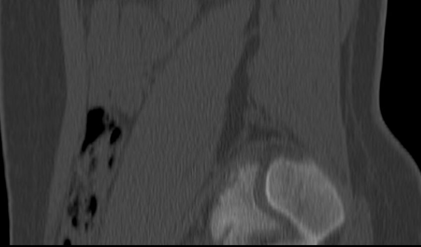 Bilateral pars defect (Radiopaedia 26691-26846 Sagittal bone window 8).jpg