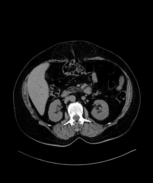 File:Bilateral sporadic synchronous clear cell renal cell carcinoma (Radiopaedia 85035-100572 Axial non-contrast 29).jpg