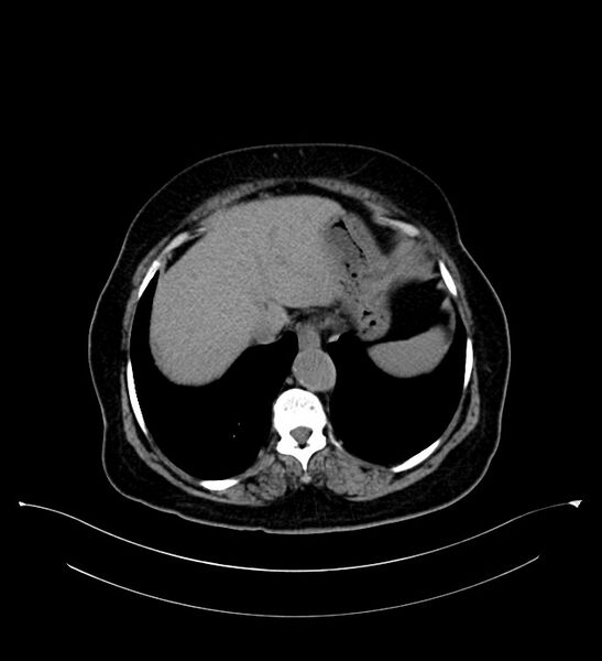 File:Bilateral sporadic synchronous clear cell renal cell carcinoma (Radiopaedia 85035-100575 Axial non-contrast 10).jpg
