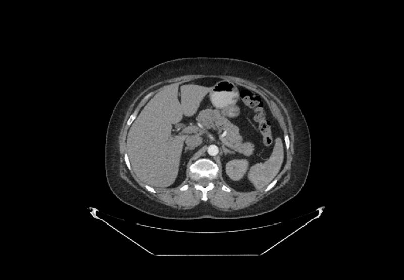 File:Bilateral urolithiasis with incidentally detected splenic artery aneurysm and left inferior vena cava (Radiopaedia 44467-48127 A 18).jpg