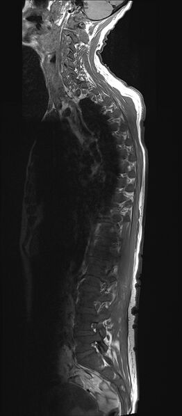File:Bing-Neel syndrome (Radiopaedia 71453-81799 Sagittal T1 1).jpg