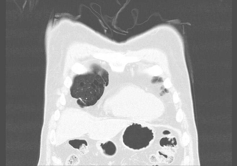 File:Birt-Hogg-Dubé syndrome (Radiopaedia 52578-58491 Coronal lung window 1).jpg