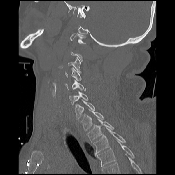 File:Blunt cerebrovascular injury (Radiopaedia 53682-59743 Sagittal bone window 15).png