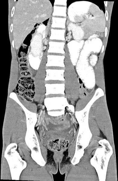 File:Blunt injury to the small bowel (Radiopaedia 74953-85987 B 61).jpg