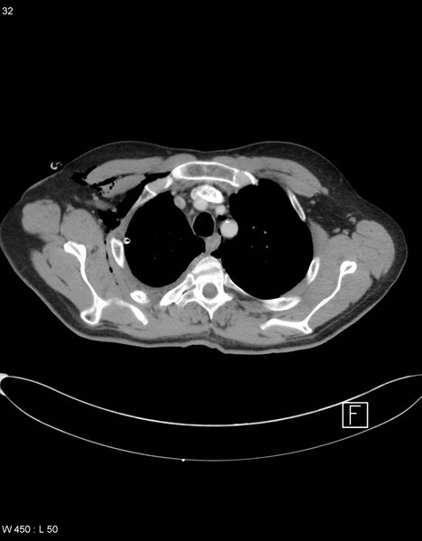 File:Boerhaave syndrome with tension pneumothorax (Radiopaedia 56794-63605 A 15).jpg