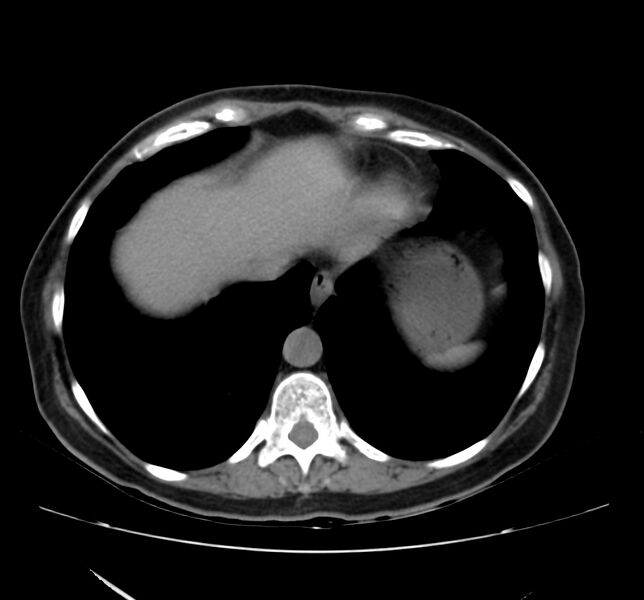 File:Bosniak renal cyst - type IV (Radiopaedia 22929-22953 Axial non-contrast 4).jpg