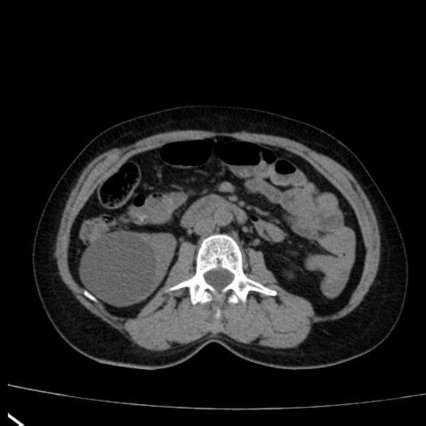 File:Bosniak renal cyst - type I (Radiopaedia 27479-27675 Axial non-contrast 44).jpg
