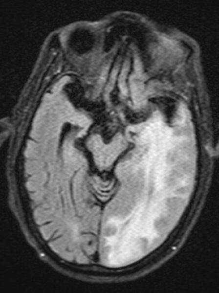 File:Brain abscess with dual rim sign (Radiopaedia 87566-103938 Axial FLAIR 9).jpg