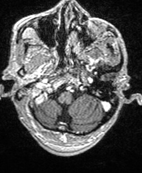 File:Brain abscess with dual rim sign (Radiopaedia 87566-103938 Axial T1 C+ 31).jpg