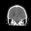 Brain death (Radiopaedia 78597-91360 Coronal non-contrast 50).jpg