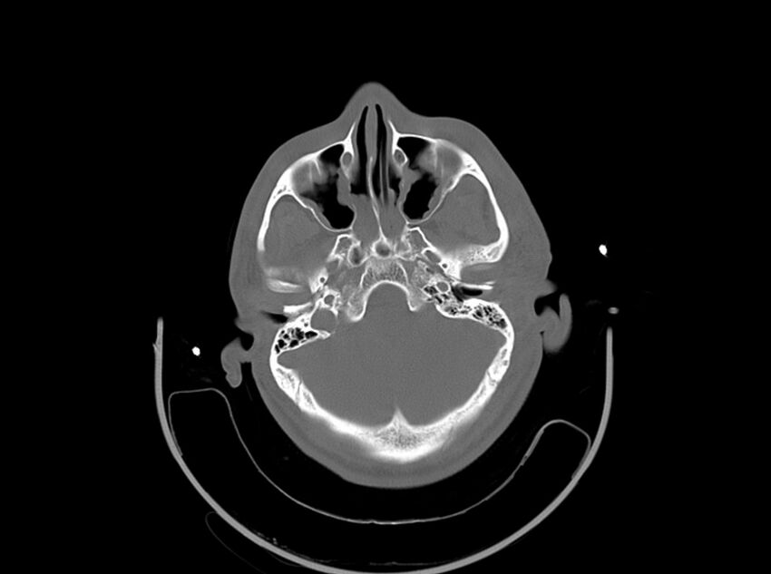 Brain injury by firearm projectile (Radiopaedia 82068-96087 A 58).jpg