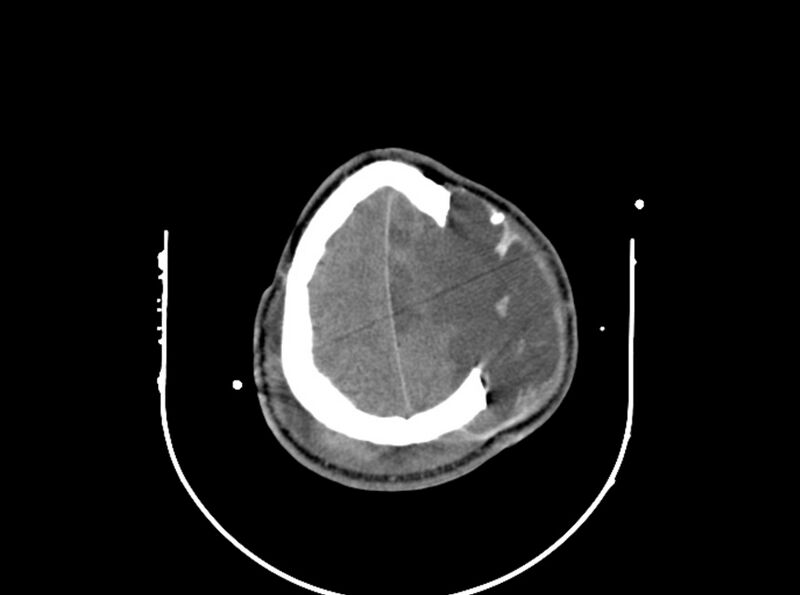 File:Brain injury by firearm projectile (Radiopaedia 82068-96087 B 156).jpg