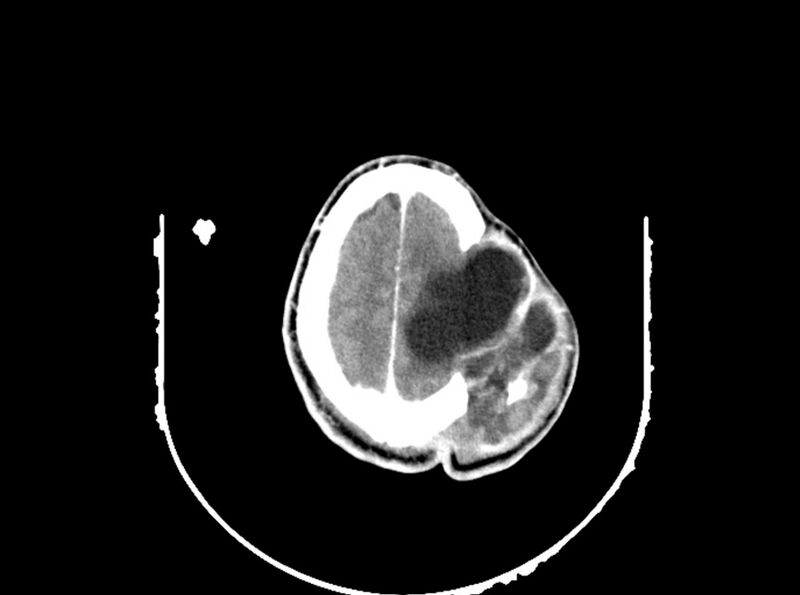 File:Brain injury by firearm projectile (Radiopaedia 82068-96088 B 181).jpg