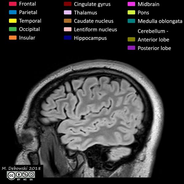File:Brain lobes - annotated MRI (Radiopaedia 61691-69700 Sagittal 10).JPG