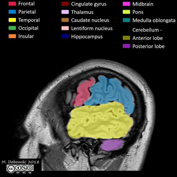 File:Brain lobes - annotated MRI (Radiopaedia 61691-69700 Sagittal 72).JPG