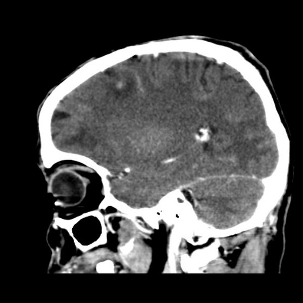 File:Brain metastases from lung cancer (Radiopaedia 24480-24781 C+ delayed 40).jpg
